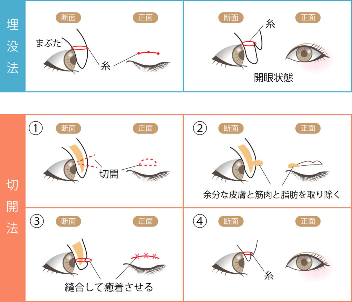 埋没法と全切開の手術の違いイラスト