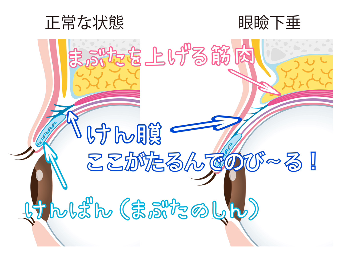 眼瞼下垂と正常の眼球のイラスト