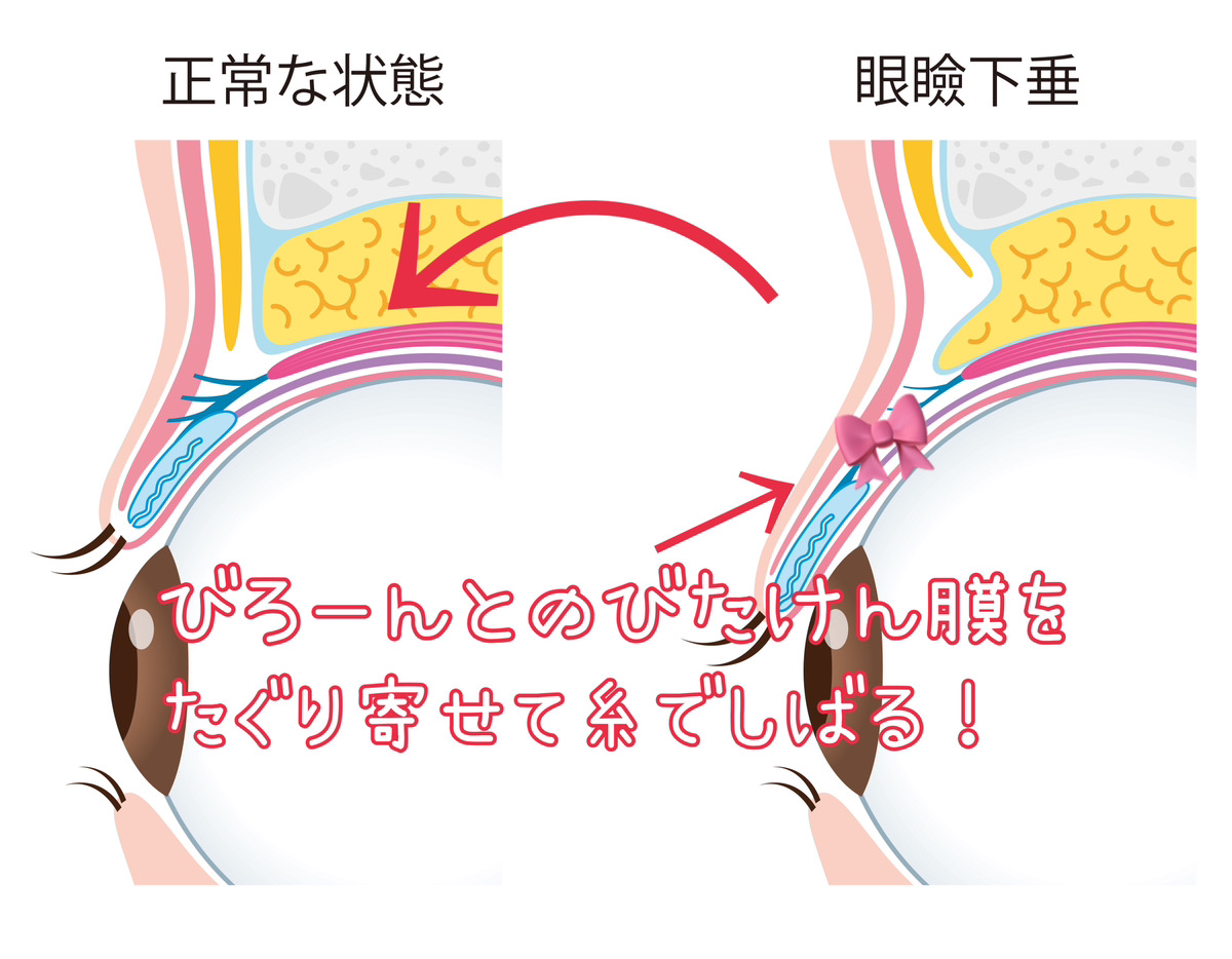 眼瞼下垂の手術　挙筋前転術（きょきんぜんてんじゅつ）手術説明のイラスト