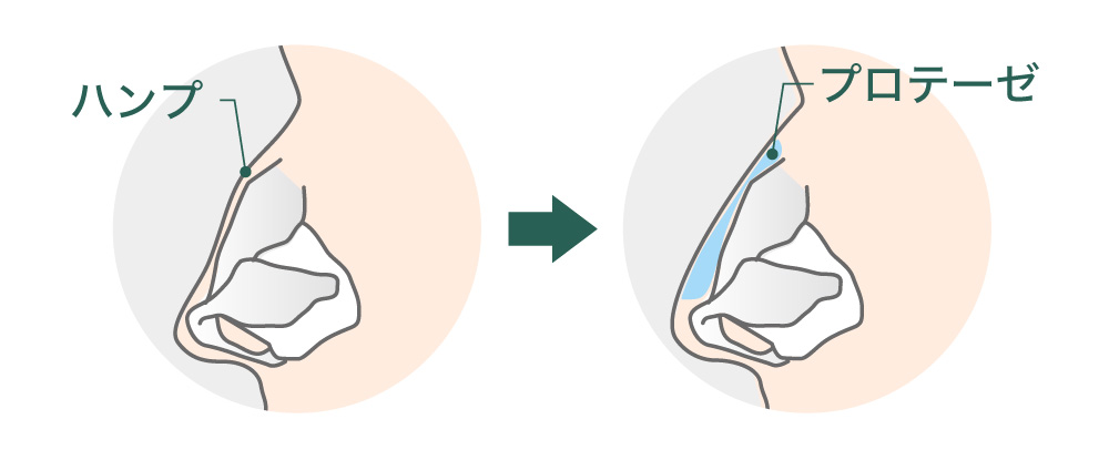 鷲鼻　プロテーゼ