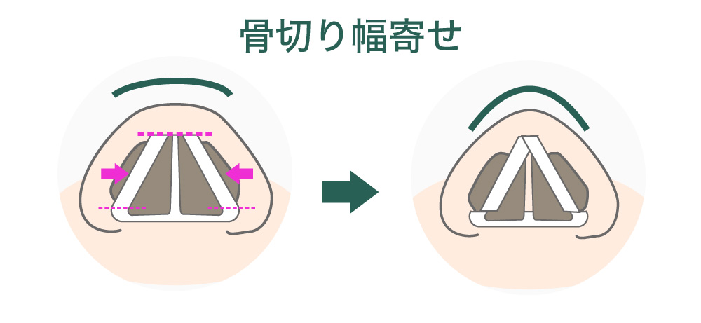 鼻の骨切り幅寄せのイメージ