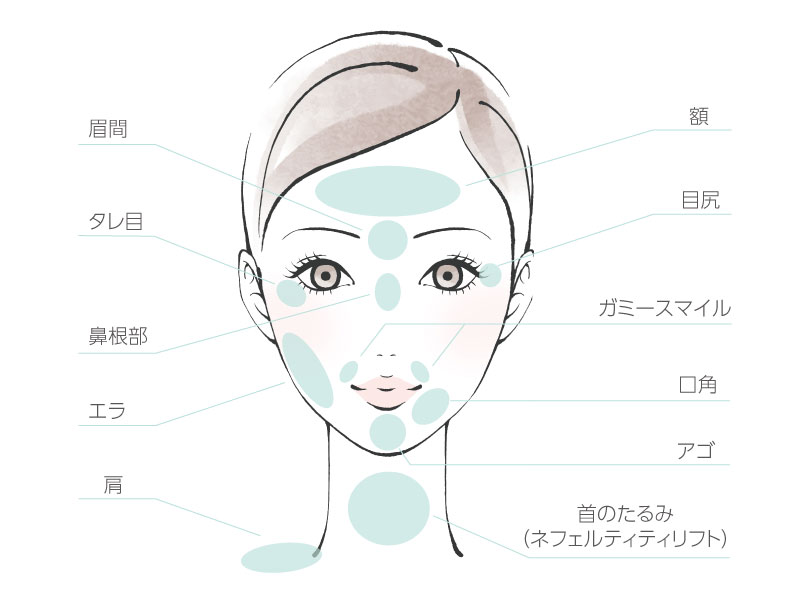 ボトックス注射によるプチ整形 ボトックス注入 恵聖会クリニック 大阪の美容外科 美容皮膚科