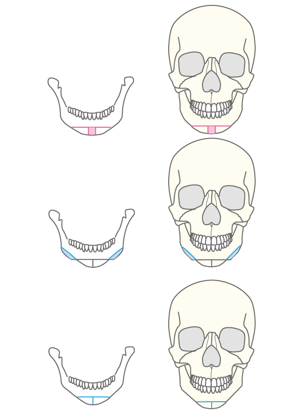 長く突き出た顎を形成し 美しい横顔へ オトガイ形成 顎骨切り 恵聖会クリニック 大阪の美容外科 美容皮膚科