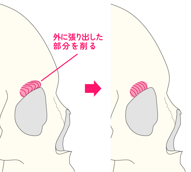 眉弓（眉骨）部分の骨削りイラスト