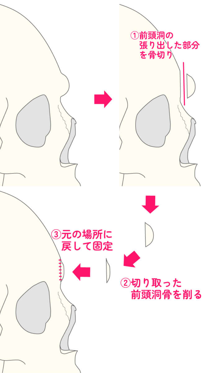 前頭洞骨切りイラスト