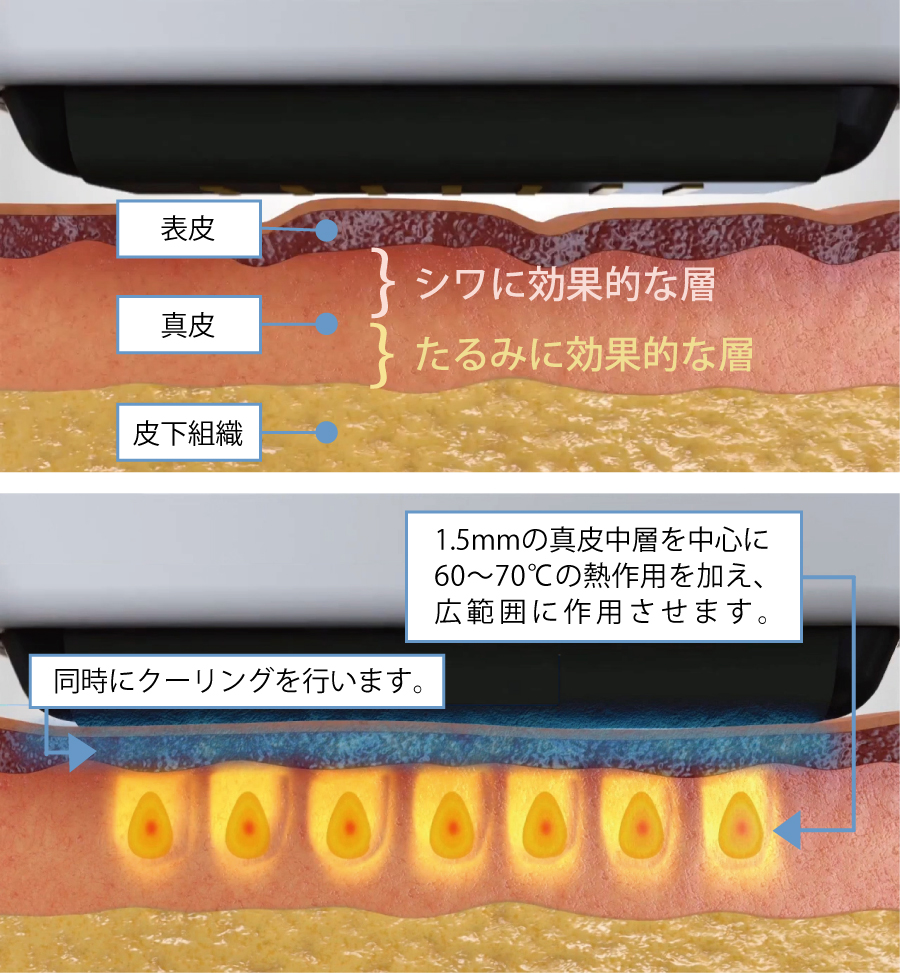 ソフウェーブのSUPERB™（スパーブ）作用イメージ