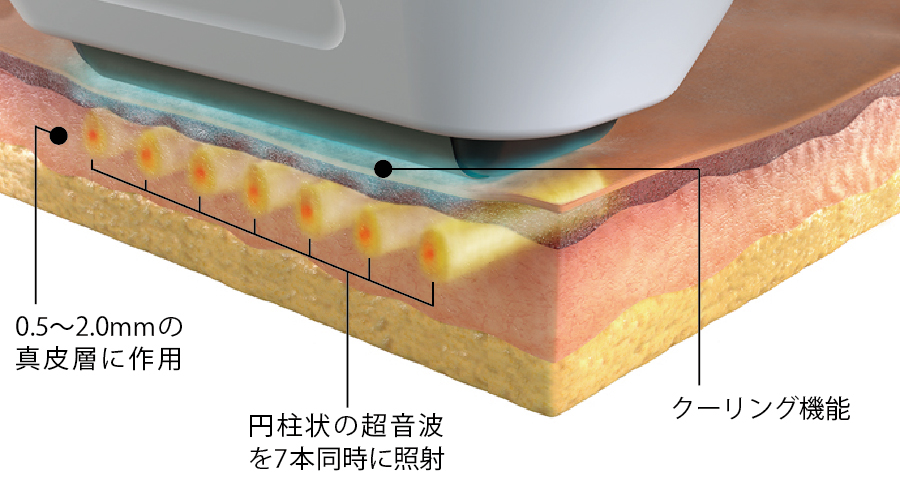 独自技術SUPERB™（スパーブ）による同期平行超音波照射