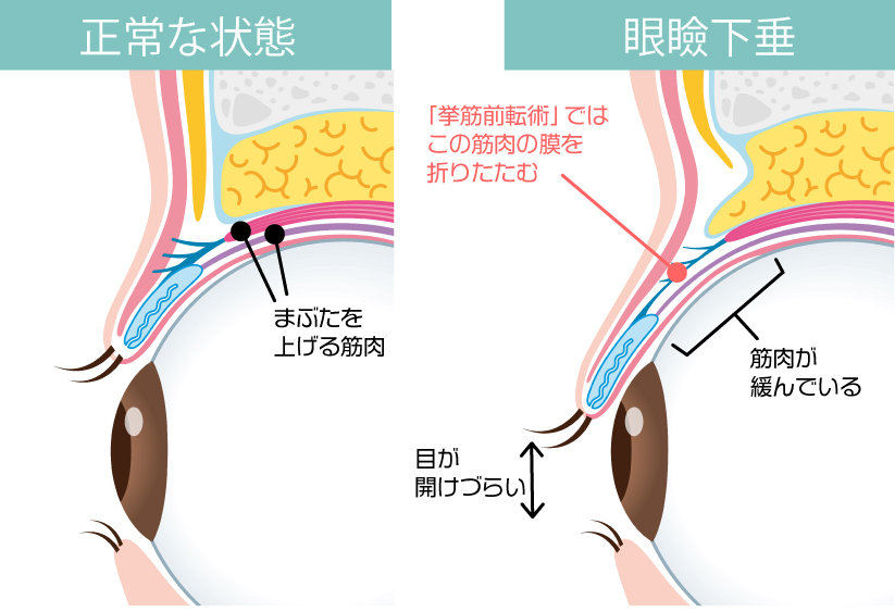 正常な状態・眼瞼下垂