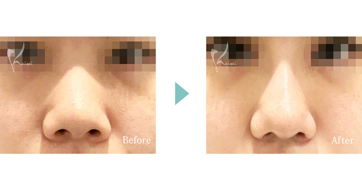 鼻の整形手術 症例写真 恵聖会クリニック 大阪の美容外科 美容皮膚科