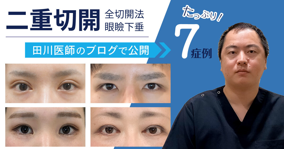二重全切開法 眼瞼下垂の症例紹介 恵聖会クリニック 大阪の美容外科 美容皮膚科