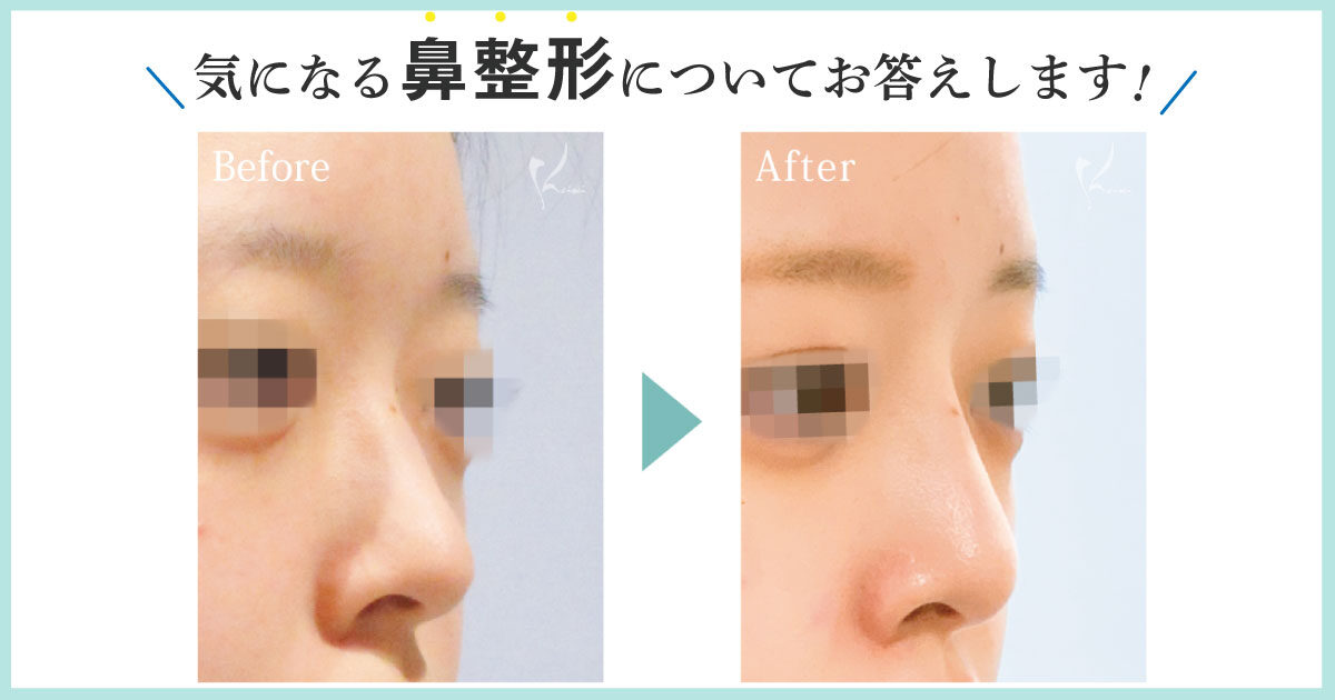 鼻整形のよくある質問 恵聖会クリニック 大阪の美容外科 美容皮膚科