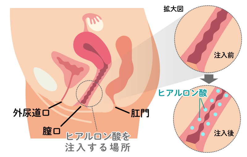 ヒアルロン酸を注入する場所イラスト